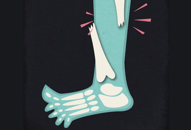 sannte-gamification-pied-fracture